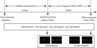 Therapeutic Effects of Transcranial Magnetic Stimulation on Visuospatial Neglect Revealed With Event-Related Potentials